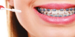 Ortodonti (Diş Teli) Tedavisi